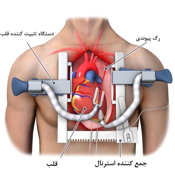 عمل قلب باز