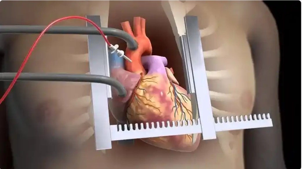 عمل قلب باز